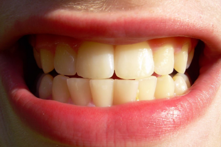 О чем говорит зубной скрежет по ночам, и как от него избавиться